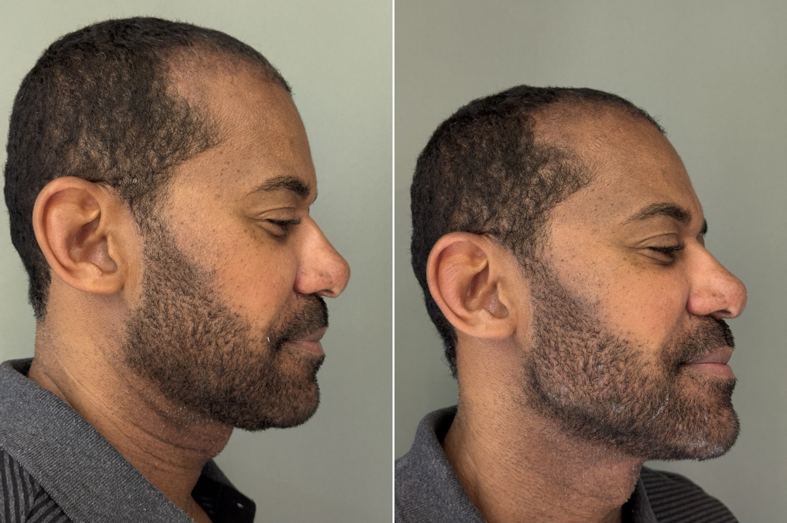 Depois do tratamento estético facial masculino