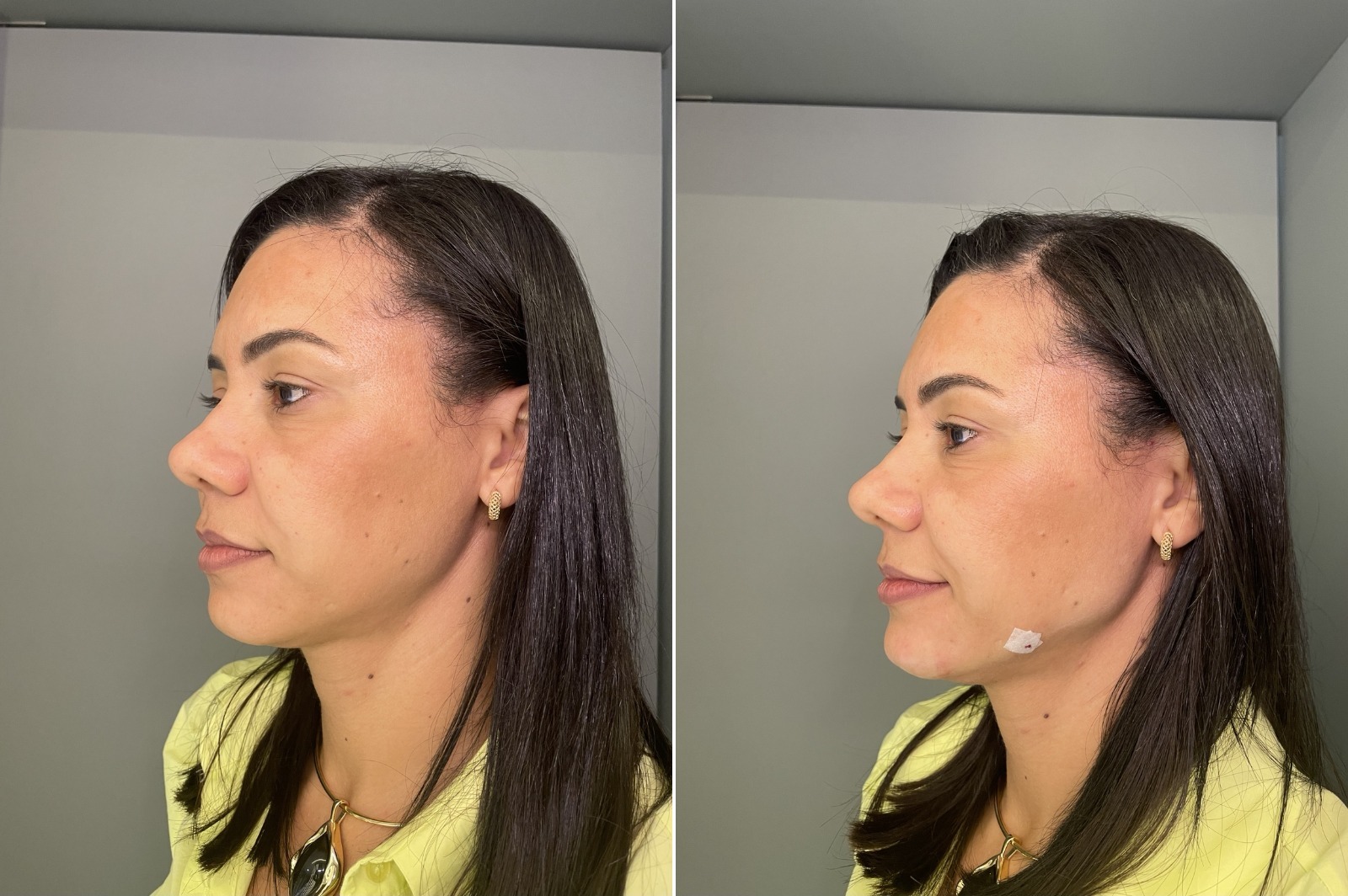 Depois do tratamento estético facial feminino