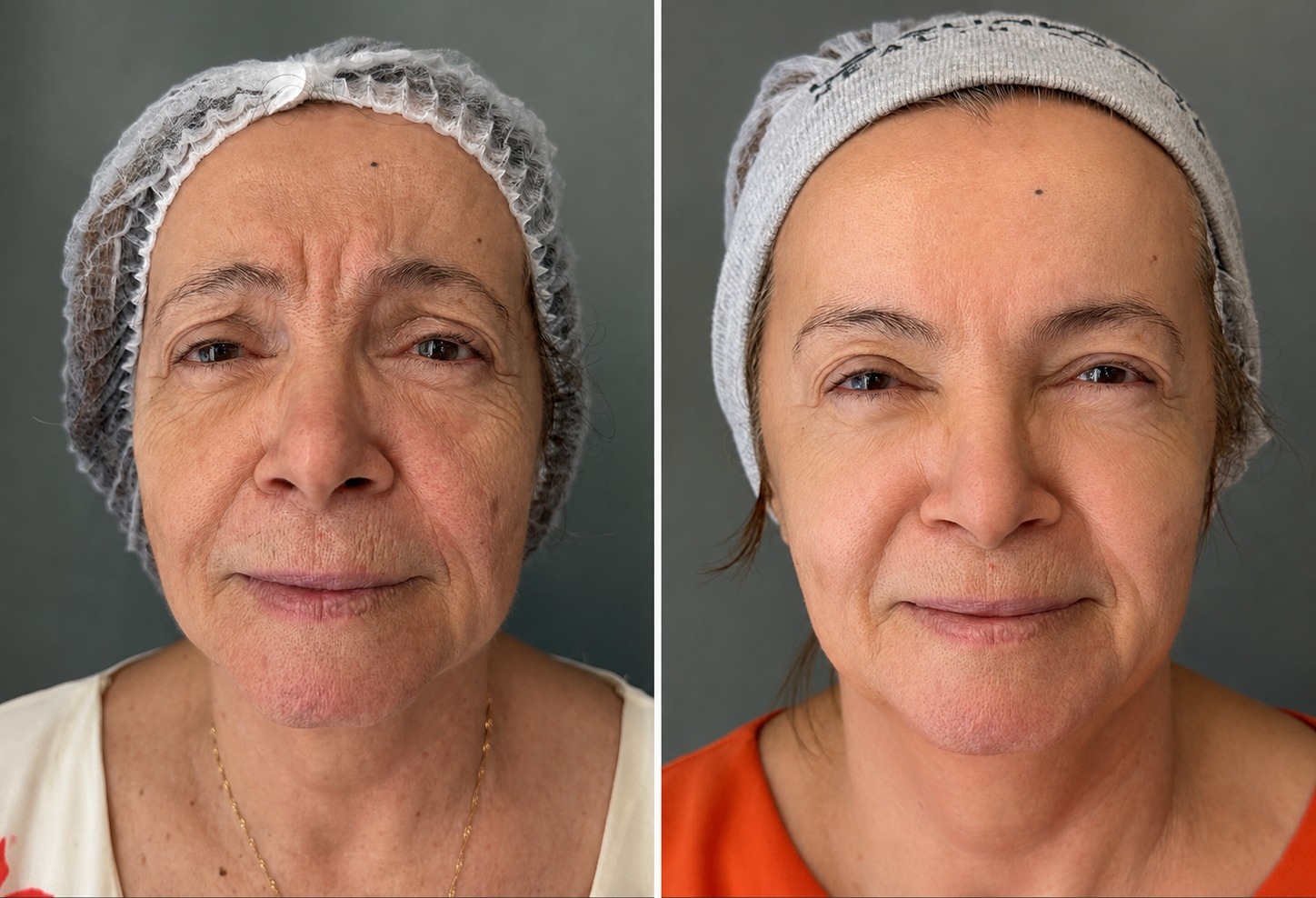 Depois do rejuvenescimento facial
